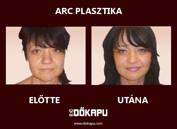 Arc plasztika
 
 title=